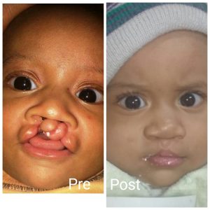 Cleft lip treatment in Hurghada